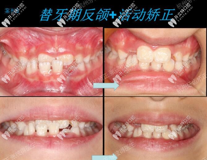 替牙期矯正