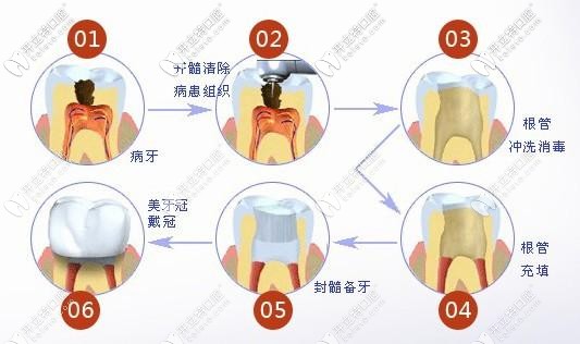 根管治療分析圖片式.jpg