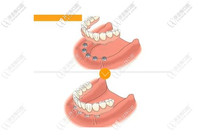 球帽半固定種植牙示意圖