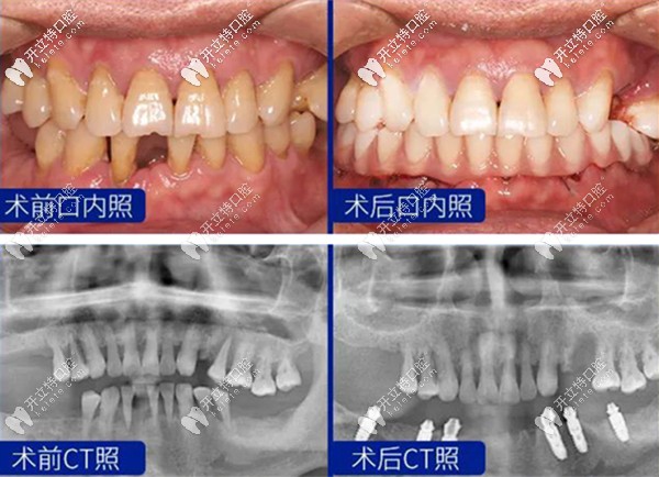 王旭醫(yī)生的半口種植牙案例效果圖