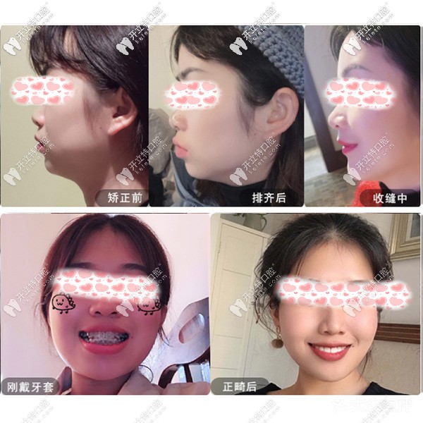 重慶樂樂欣口腔的盤龍店正畸收費(fèi)價(jià)格表搶鮮一覽