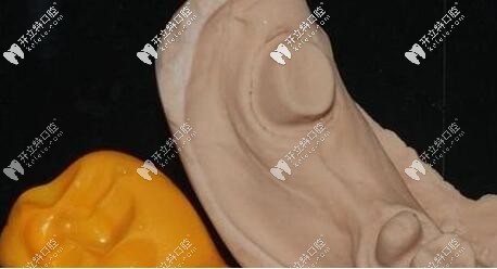 石膏模型