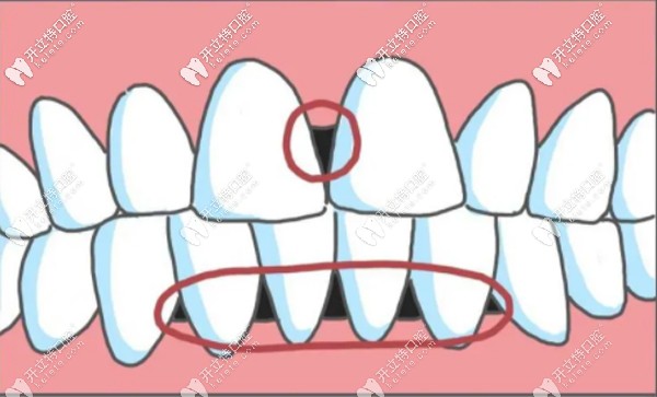 牙齒二級松動(dòng)黑三角