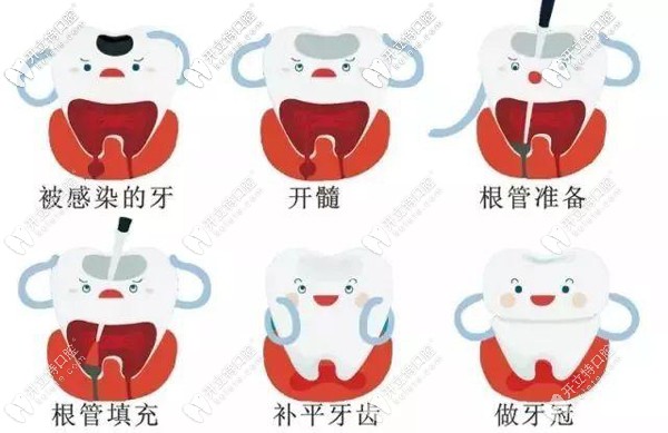 根管治療步驟
