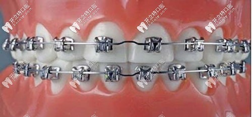 各個(gè)品牌自鎖托槽矯正的價(jià)格及優(yōu)缺點(diǎn)