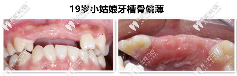 牙槽骨不足，需要植入骨粉
