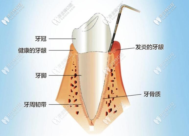 牙周炎癥