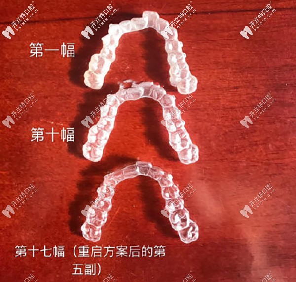 戴牙套第十副