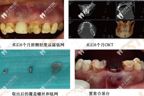 術后6個月的效果圖