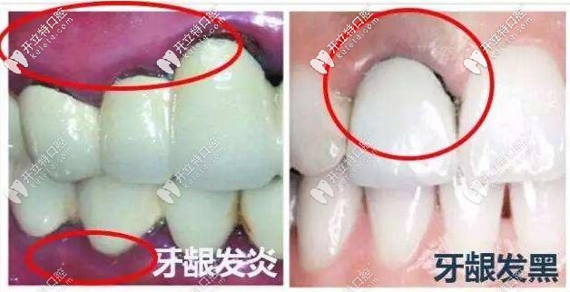 烤瓷牙的牙齦出現(xiàn)黑線怎么辦