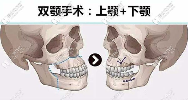 <!--<i data=20240703-sp></i>-->做骨性地包天矯正的費(fèi)用是多少？