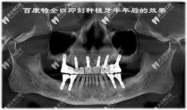 百康特全口即刻種植牙半年后的效果