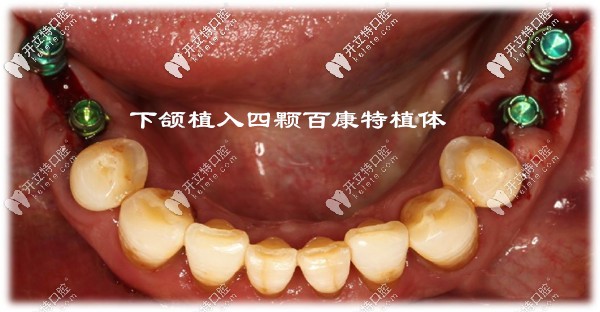 百康特即刻種植牙案例