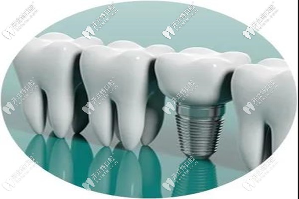 諾貝爾pmc種植體的優(yōu)勢所在