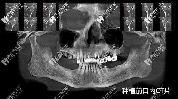 國產(chǎn)百康特種植牙質(zhì)量不輸進(jìn)口,成功運(yùn)用在全口即刻種植中