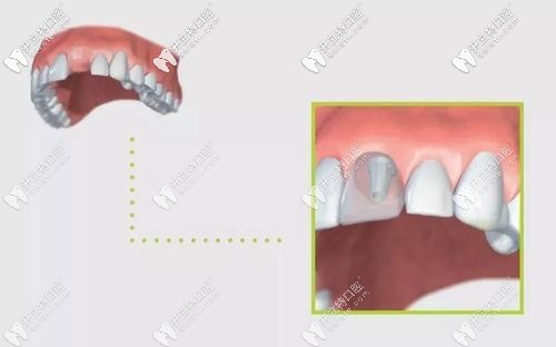可以避免牙周被破壞的種植牙新技術(shù)“盾構(gòu)術(shù)”了解一下？