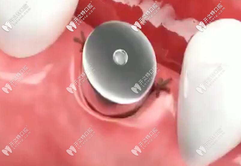 安裝愈合基臺(tái)，縫合傷