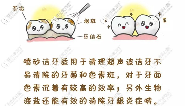 噴砂洗牙與超聲波洗牙的區(qū)別