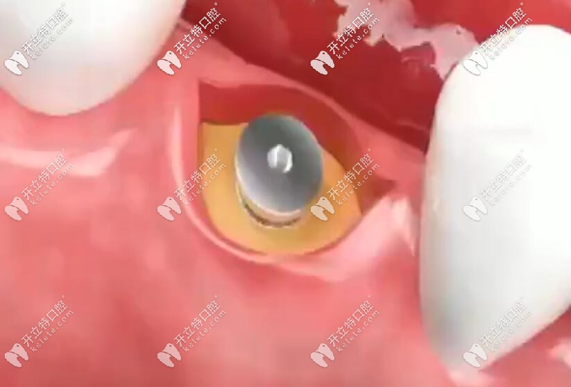 切開(kāi)牙齦取覆蓋基臺(tái)
