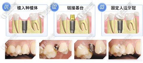做種植牙二期手術(shù)過(guò)程