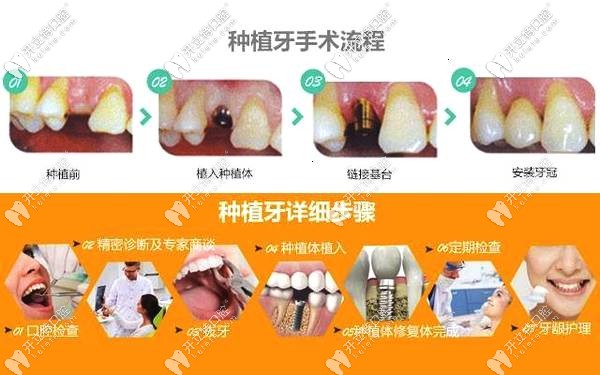 超詳細(xì)的種植牙二期上基臺(tái)步驟