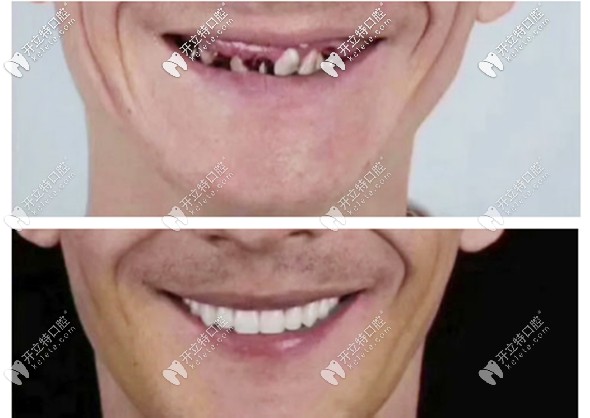 半口種植6顆牙根的效果圖