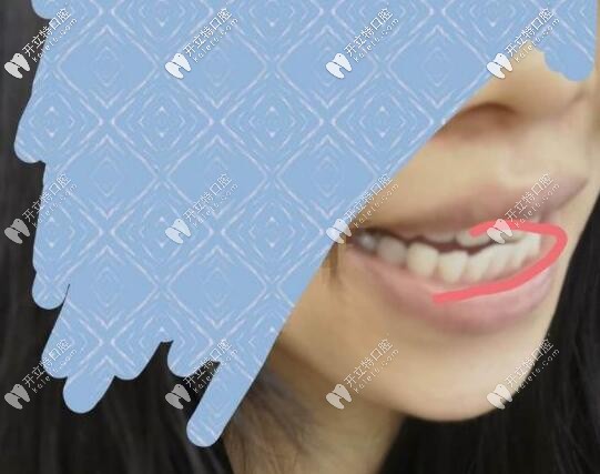 牙齒矯正反彈
