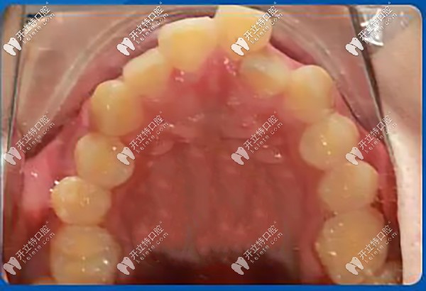 牙齒重度擁擠不齊，牙弓狹窄