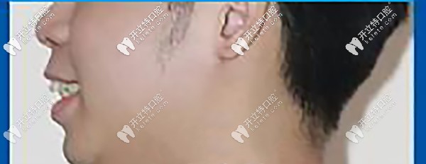 側(cè)面顯凸嘴，唇型厚重，唇肌緊張