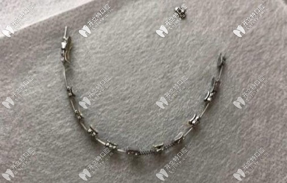 牙齒反彈后做二次矯正,這次正畸的效果和時間都在意料之外