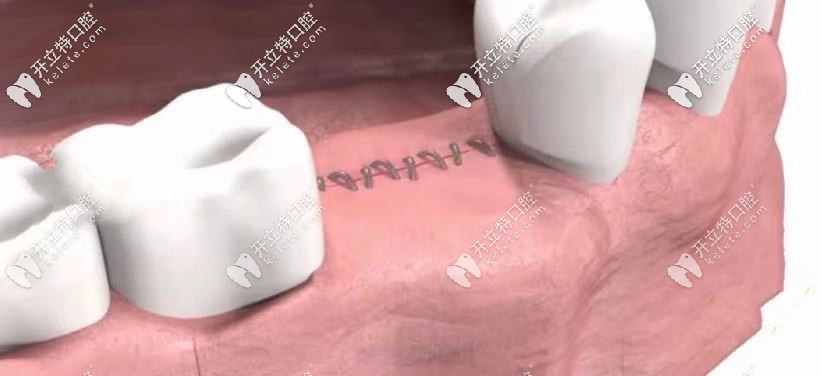 在縫合傷口后，經(jīng)過時間愈合：7天左右即可拆線