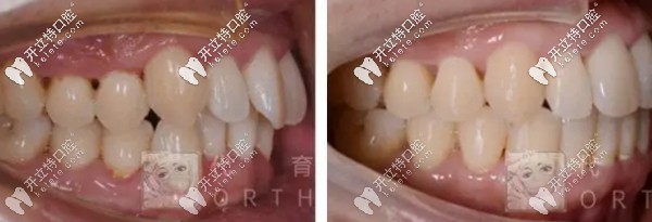 代育桐醫(yī)生矯正案例一