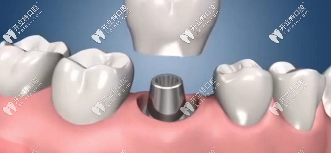 安裝基臺將牙冠和種植體連接固定，完成種植牙種植