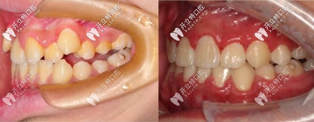 矯正前后對比
