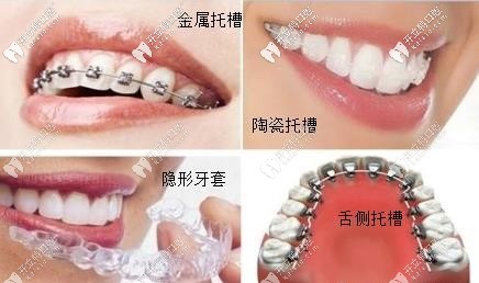 ebrace舌側(cè)矯正牙套大概多少費(fèi)用?效果相較于唇側(cè)哪個(gè)好