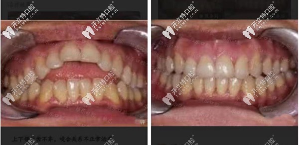 福州維樂重度開合矯正<span style=