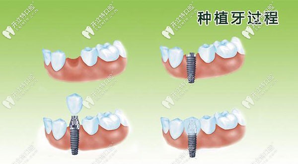 牙齒可以當天拔牙當天種植嗎