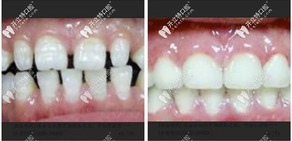 福州維樂牙齒稀疏矯正<span style=