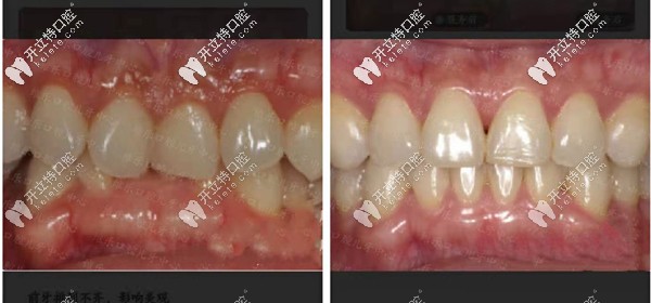 福州維樂深覆合牙矯正<span style=