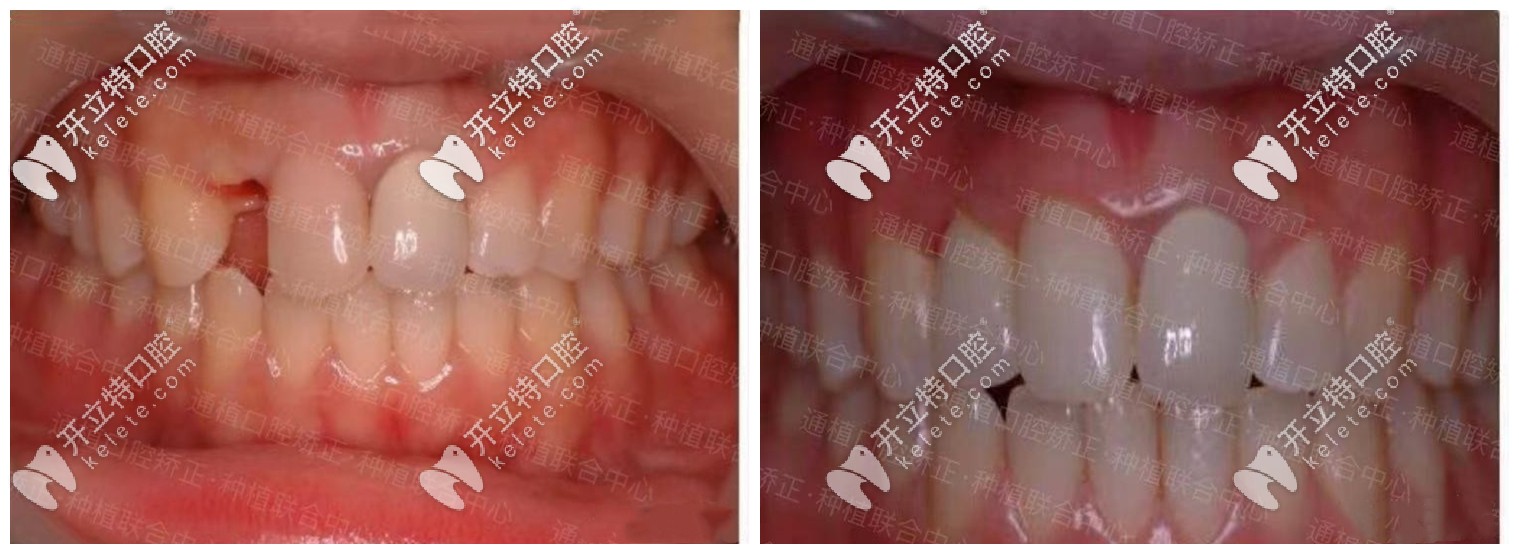 <!--<i data=20240703-sp></i>-->口腔種植牙案例