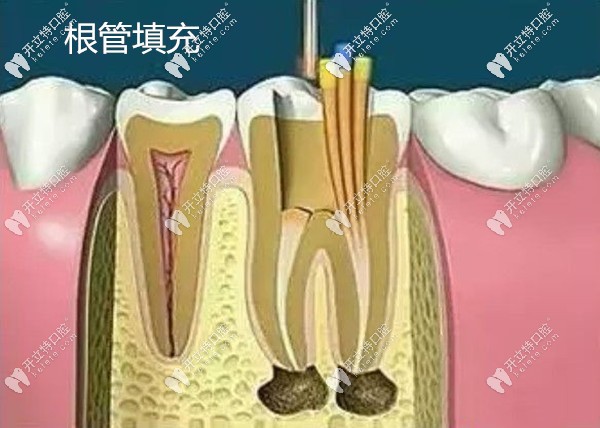 根管治療步驟三根管填充