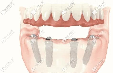 一日得種植牙技術(shù)