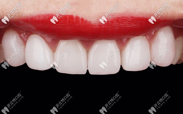 價(jià)格相差不多的國產(chǎn)和進(jìn)口全瓷牙效果圖