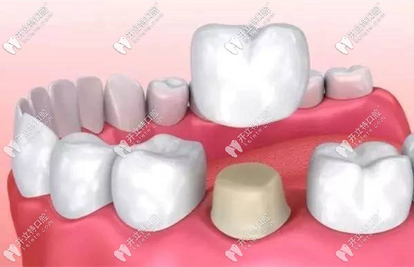 全瓷牙國產(chǎn)和進(jìn)口的區(qū)別