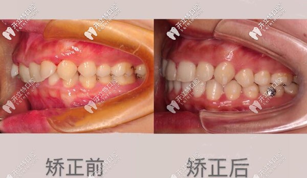 矯正案例