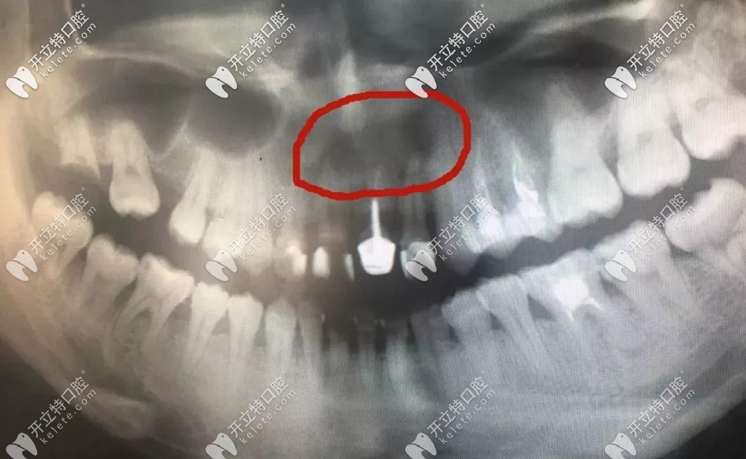 牙根尖的囊腫