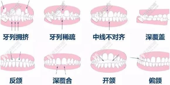 合肥美奧口腔牙齒矯正適應(yīng)癥