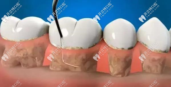 刮治或根面平整術(shù)示意圖