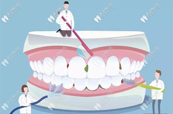 洗牙之齦上潔治
