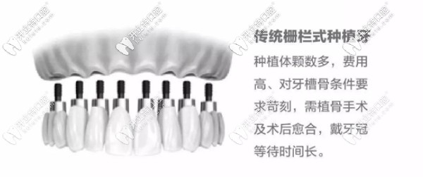 傳統(tǒng)種植牙